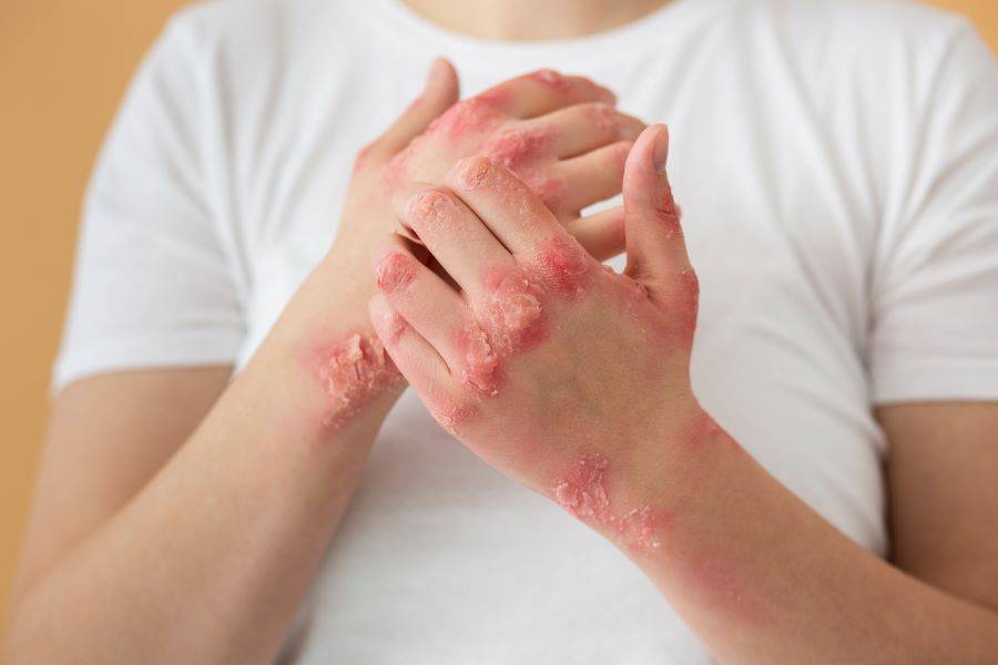 Radiation-induced dermatitis