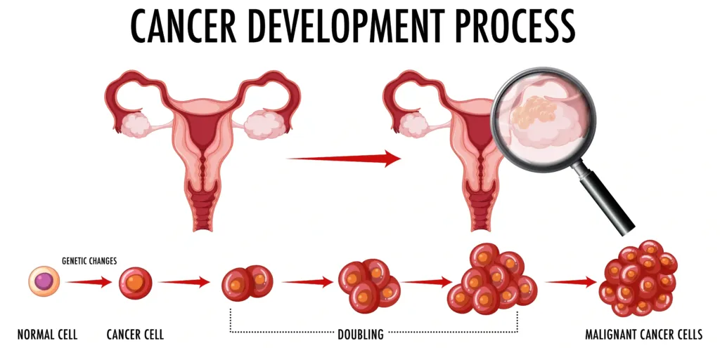 Common Ovarian Cancer Symptoms