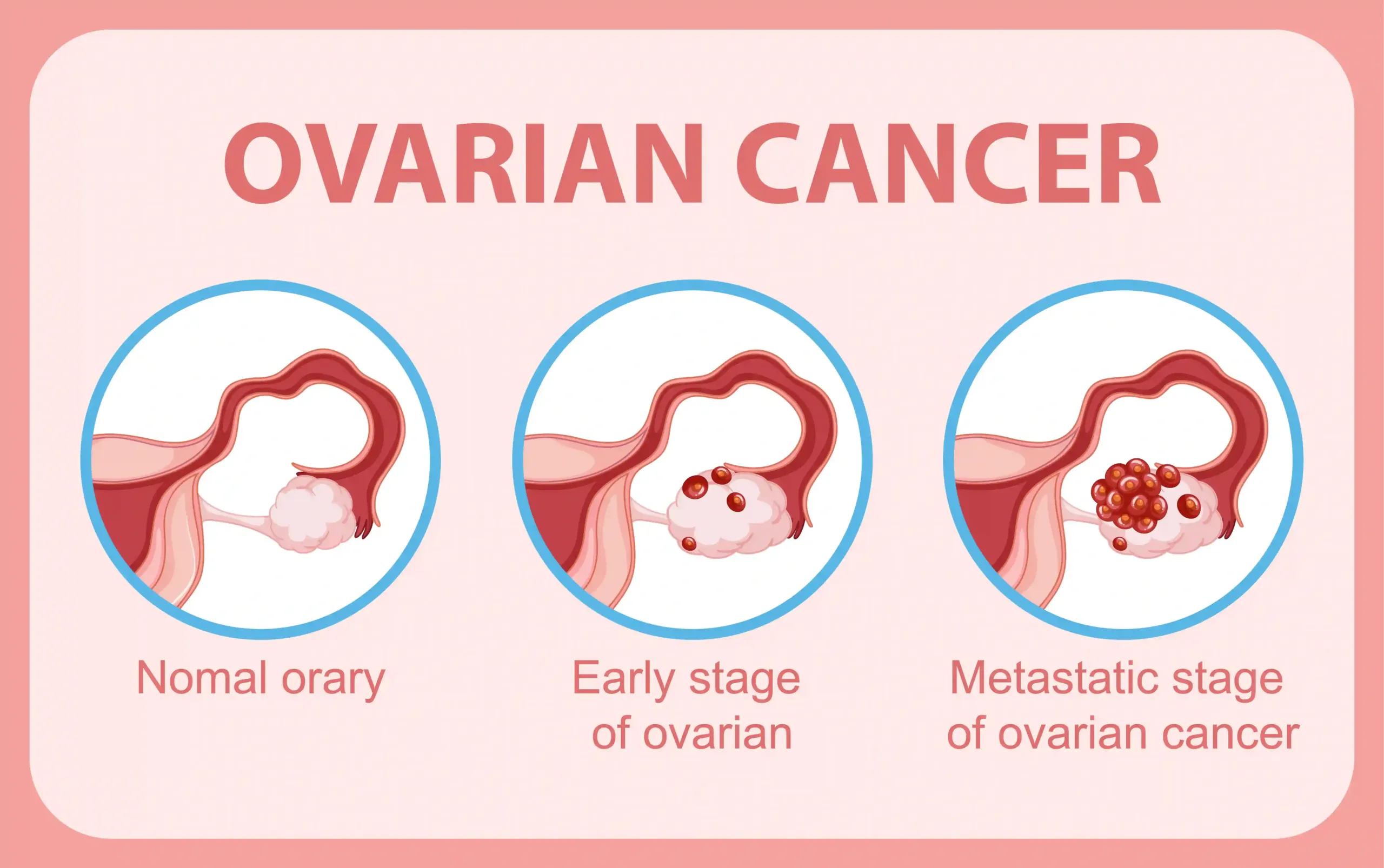 ovarian cancer symptoms
