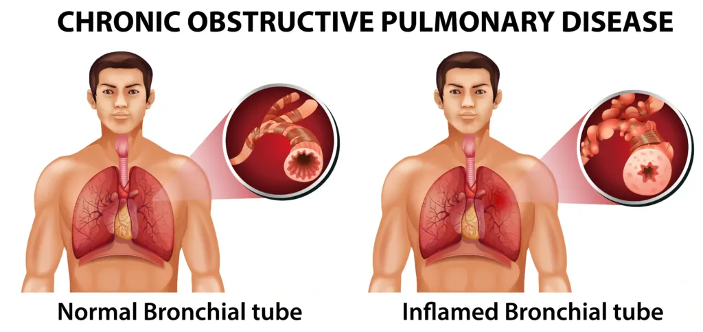 Common types of lung cancer