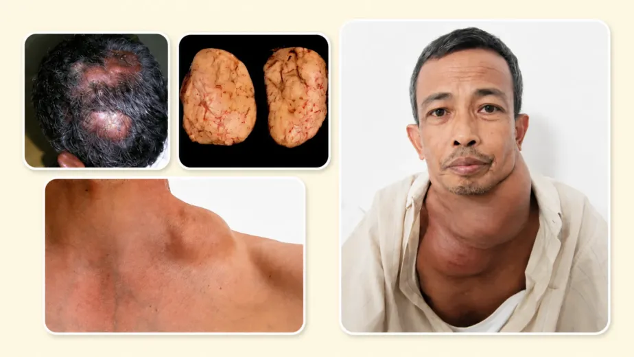 Hodgkin's Lymphoma: Understanding the Causes, Symptoms, Cancer Stages, and Advances in Oncology