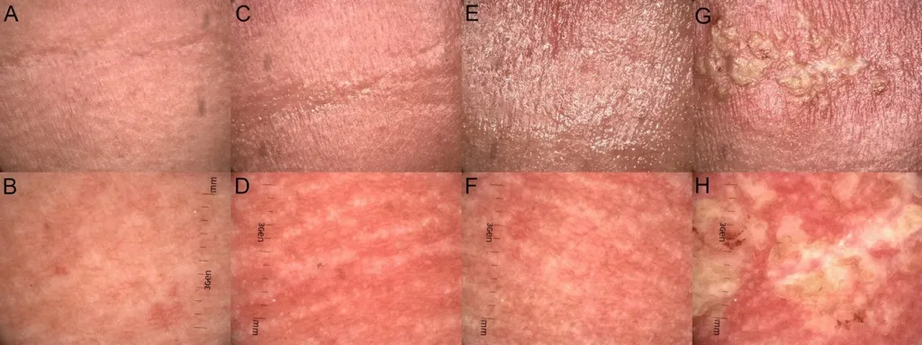 Radiation Skin Reactions: More Common Than Many Realise