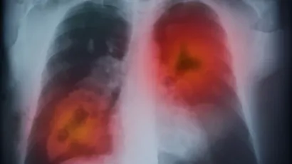 Causes of Lung Cancer Disease Understanding the Rising Burden, Risk Factors, and Early Warning Signs