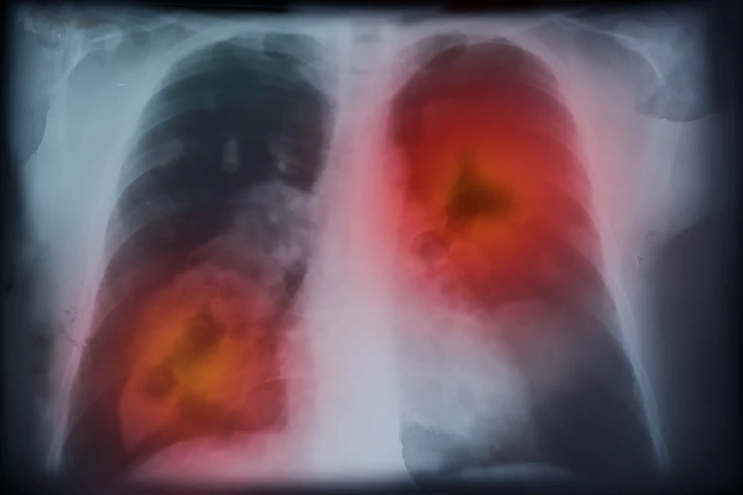 Causes of Lung Cancer Disease Understanding the Rising Burden, Risk Factors, and Early Warning Signs