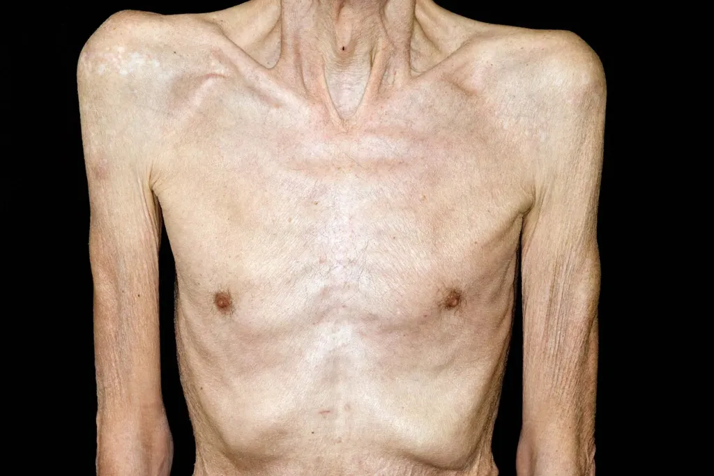 When Weight Loss Is More Than Weight Loss
